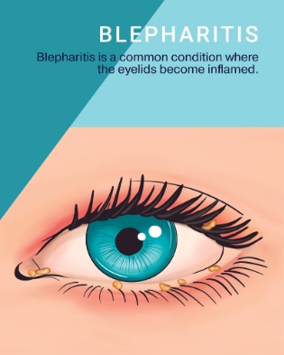 Blepharitis Brochure